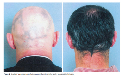 Alopecia Custom Blend